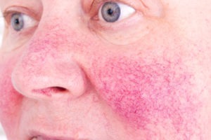 rosacea causes and symptoms