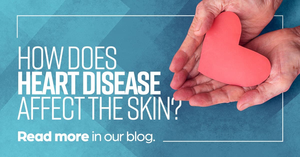 How heart disease affects the skin