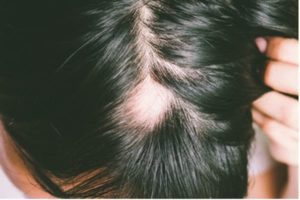 Close up photo of man displaying alopecia balding spot.