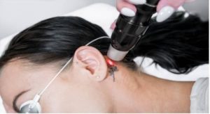 Picosure laser machine removing a tattoo on a young woman.