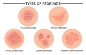 Types of psoriasis depicted in cartoon image.