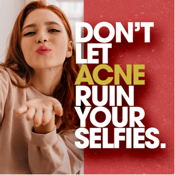 Don't let acne ruin your selfies.