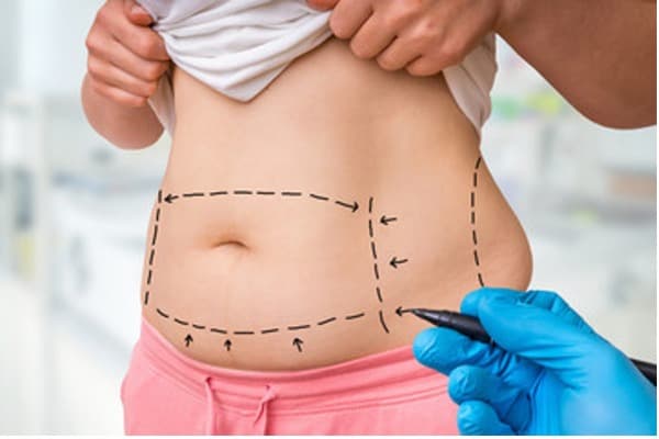 Image of doctor drawing drawing outline for liposuction on stomach.