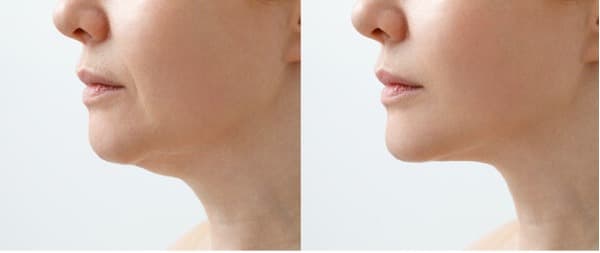 Photo before and after neck liposuction.