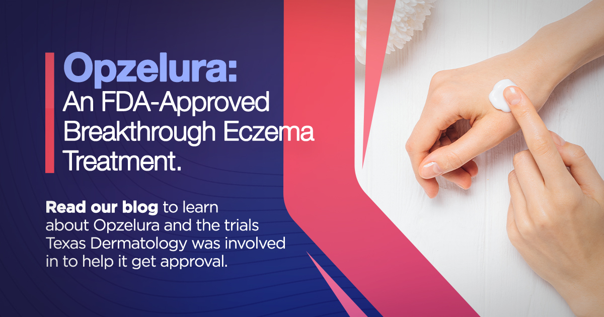 Opzelura: An FDS-approved breakthrough eczema treatment. Read our blog to learn more about opzelura and the trials Texas Dermatology was involved in to help it get approved.
