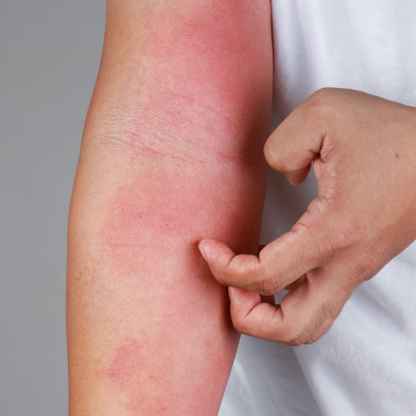 Adult scratching eczema on their arm