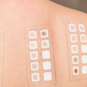 Allergy Patch Testing VS. Prick Testing: Which is Best?
