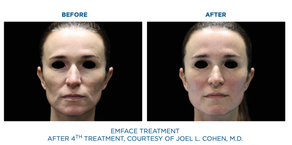 Before and After. Emface treatment after 4th treatment, courtesy of Joel L. Cohen, M.D. 