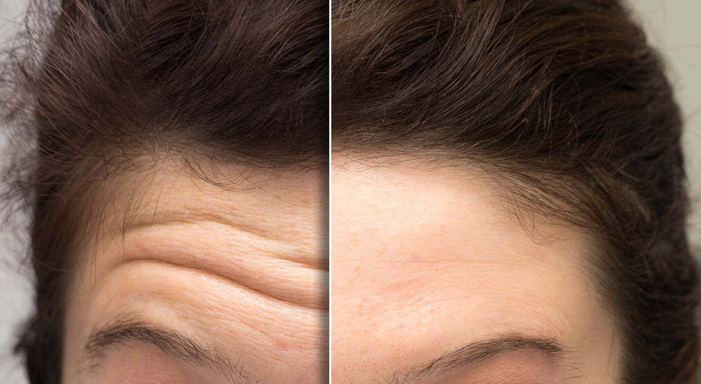 womans forehead before and after Botox treatment showing smoother skin